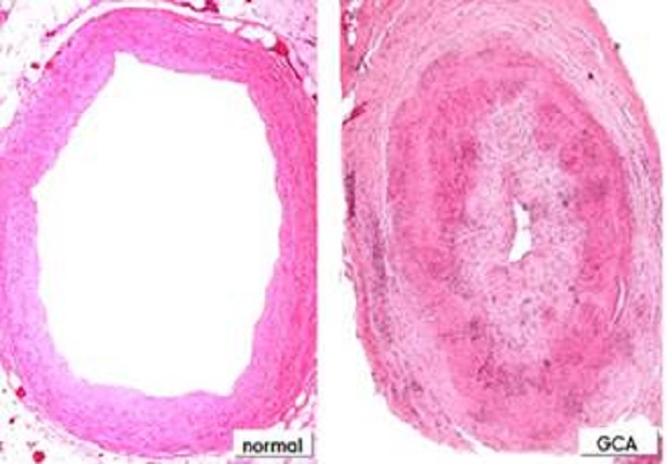 arteritis de celulas gigantes