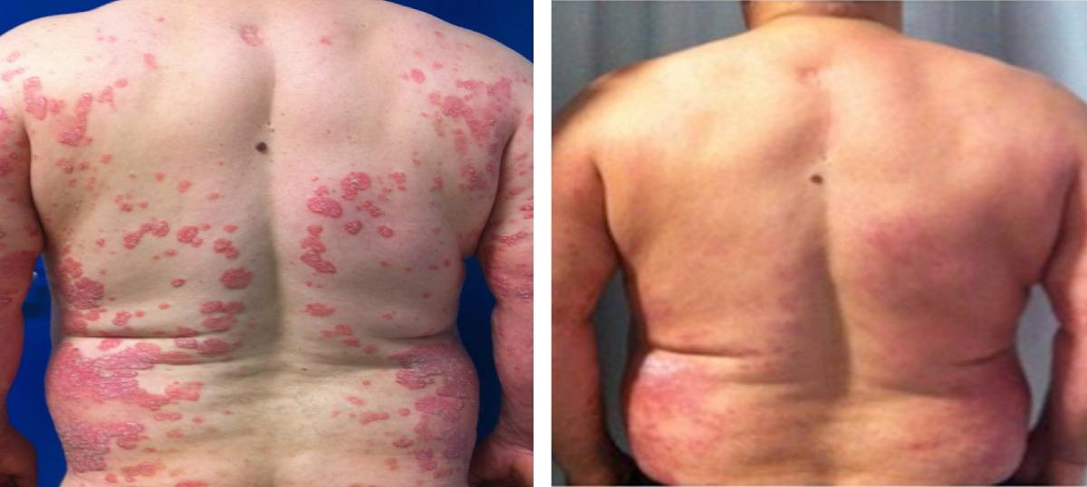 Lesiones psoriásicas del paciente antes y después del tratamiento. (FUENTE: H. Virgen del Roco)