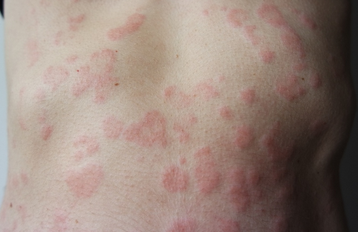 Resultado de imagen para Urticaria