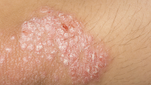 Psoriasis TodoDermo TodoDermo