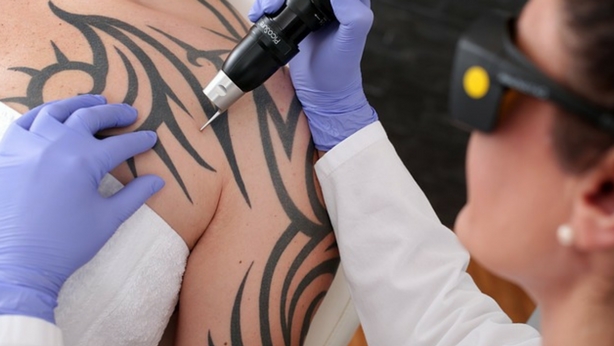 Remocion de tatuajes con laser antes y despues de adelgazar