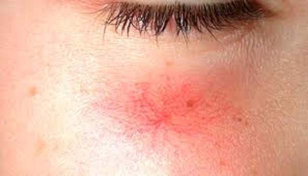 crema hidratante para piel grasa con rosacea crema hidratante para piel grasa con rosacea
