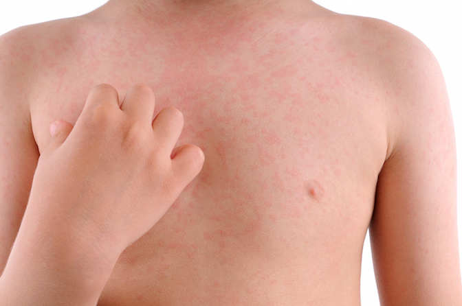 el prurito es contagioso el prurito es contagioso
