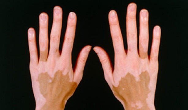 Resultado de imagen para vitiligo fotos